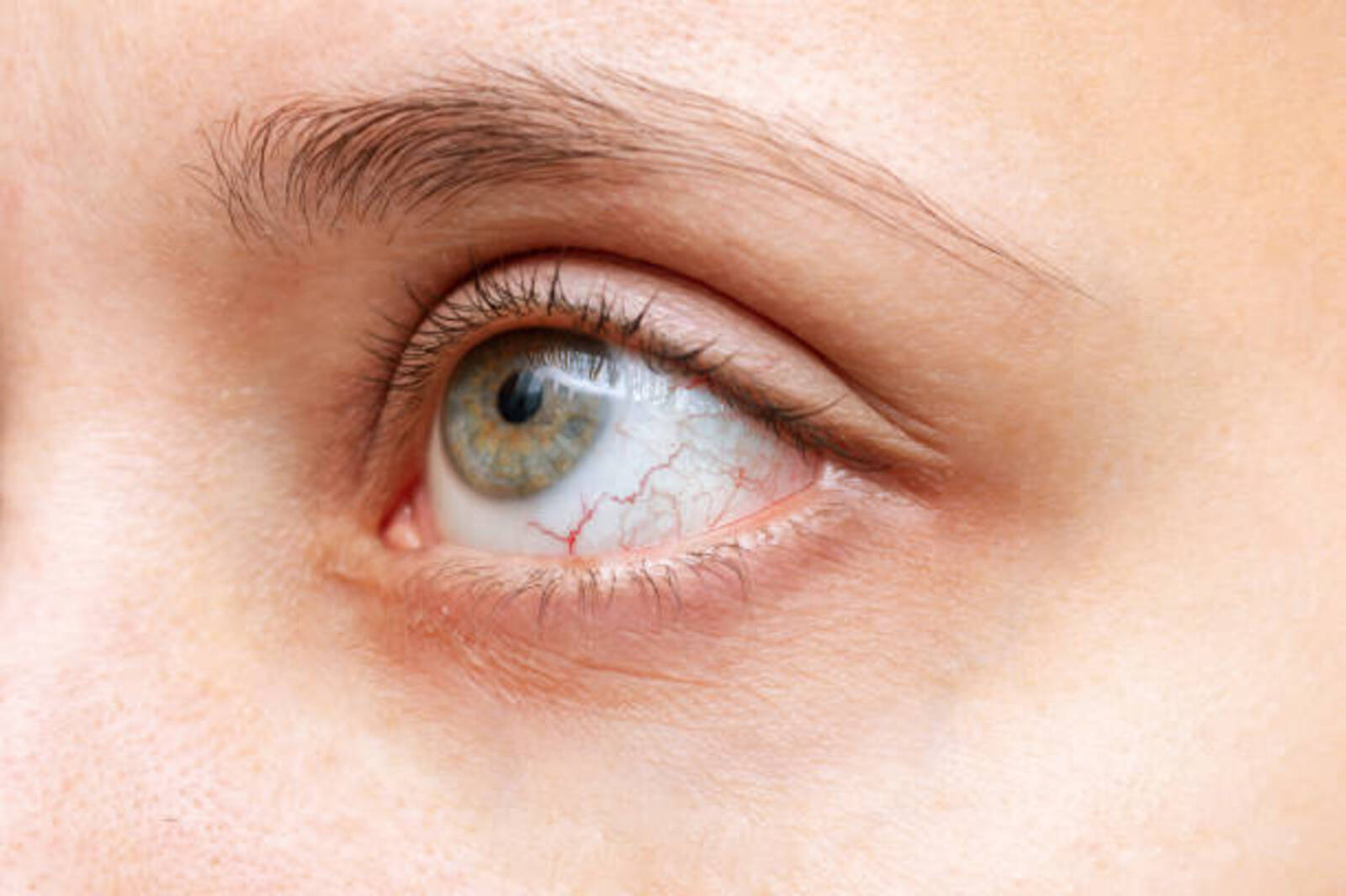 Close-up of woman's eye with red inflamed and dilated capillaries. Hemorrhage under the conjunctiva. Disease of retina of the eye. Conjunctivitis, keratitis, dry eye syndrome, trauma, uveitis